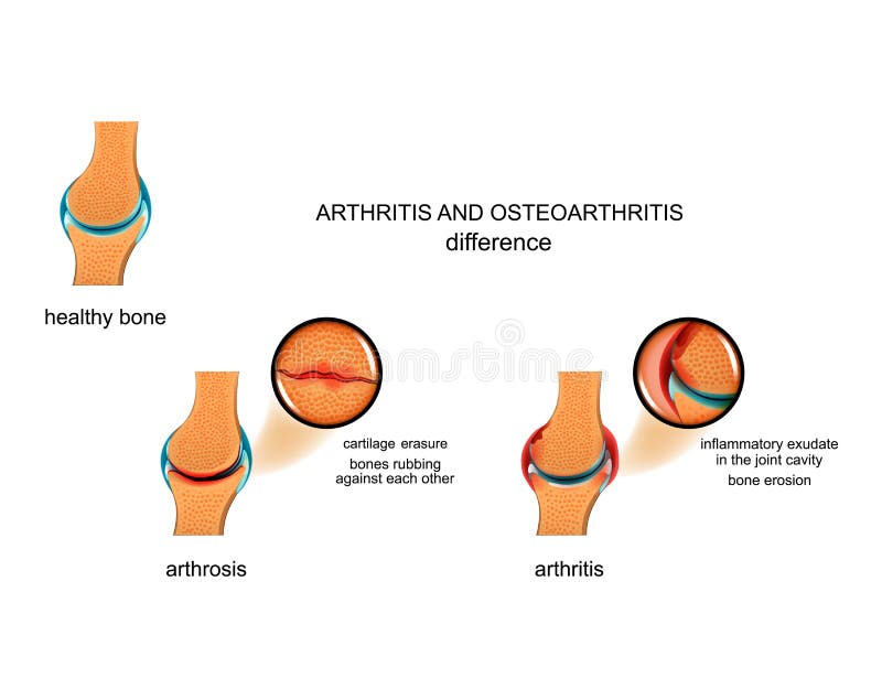 Vector illustration of the difference between arthrosis and arthritis. Vector illustration of the difference between arthrosis and arthritis